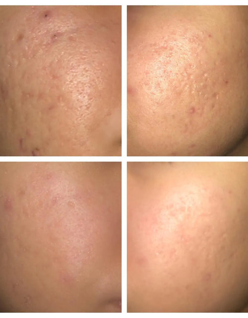 Load image into Gallery viewer, 30ml AHA 30% + BHA 2% Face Peeling Solution: Skin Care Serum
